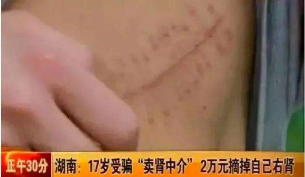 10年前卖肾换iPhone 4的小伙现状:3级伤残、终日躺床上-汇美优普