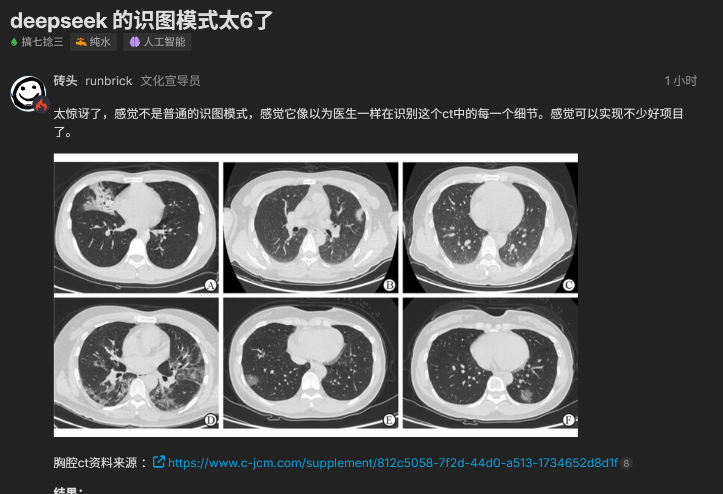 DeepSeek V4 Adds Image Analysis for CT Scans